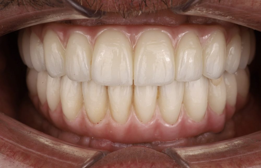 Незнімний протез на імплантах зблизька — реальна робота SM Dental